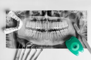 бруксизм профилактика